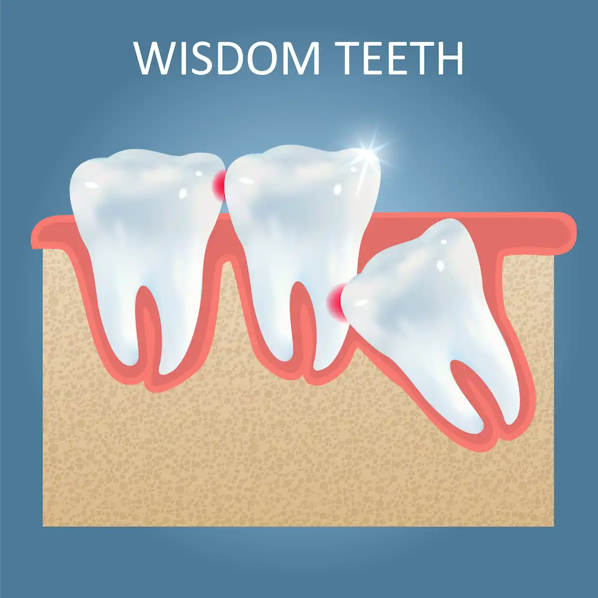 Wisdom Teeth